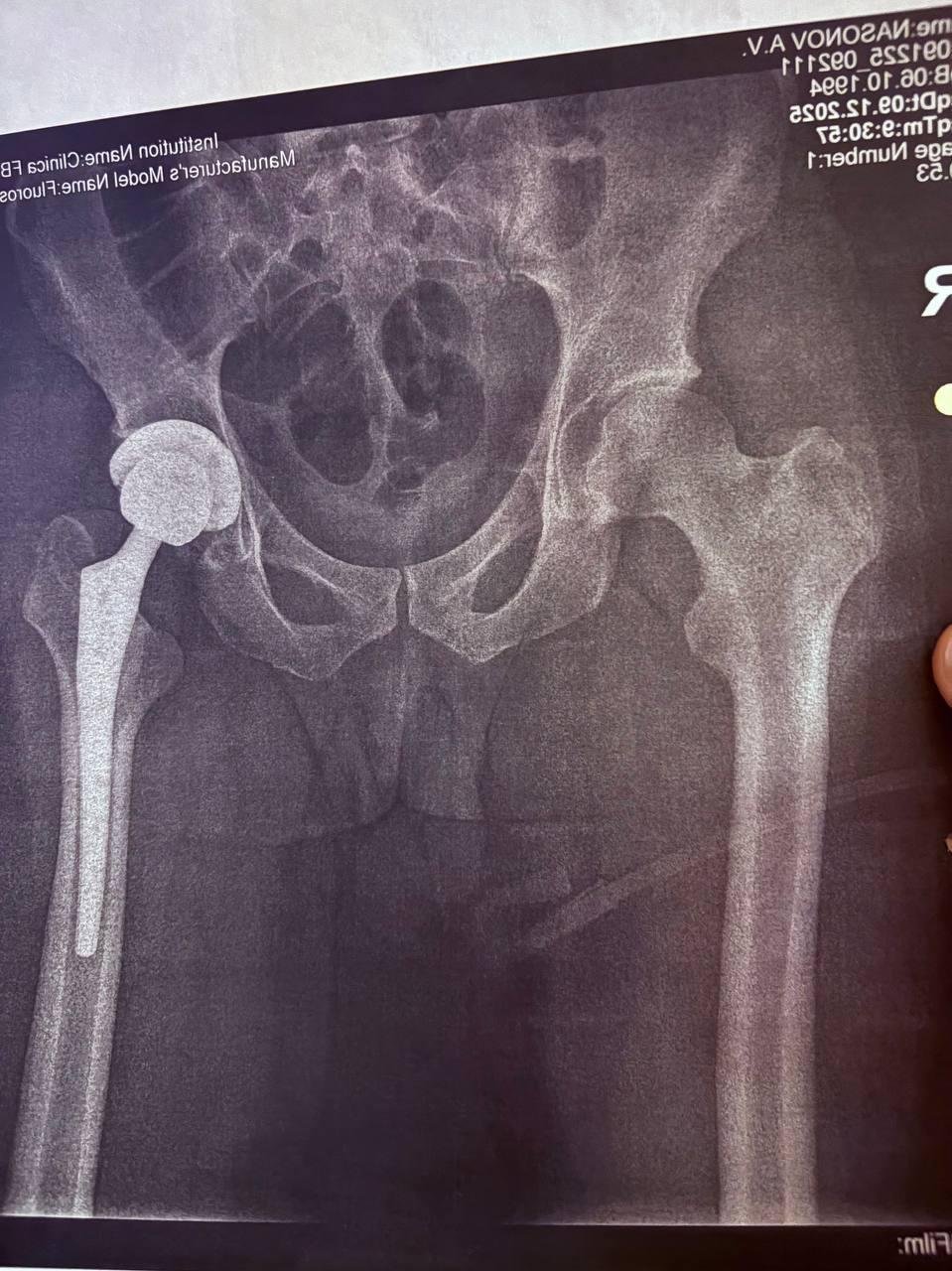 как теперь выглядит мой сустав, шутки про magic wand принимаются