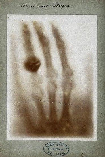 Первый рентгеновский снимок в мире - позитив