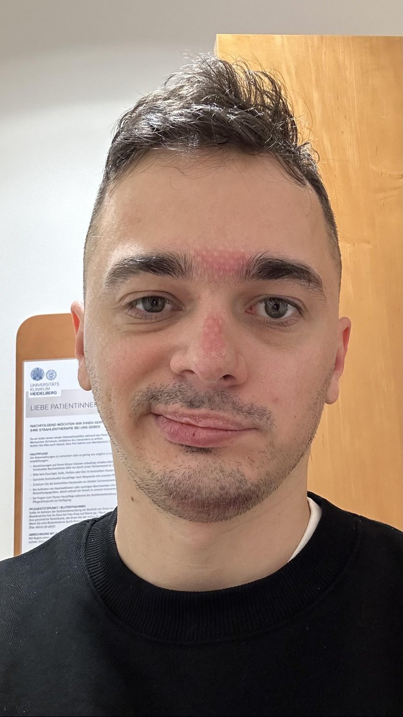 Следы от маски